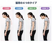 猫背タイプ分けイメージ
