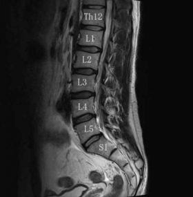 腰骨のレントゲン写真
